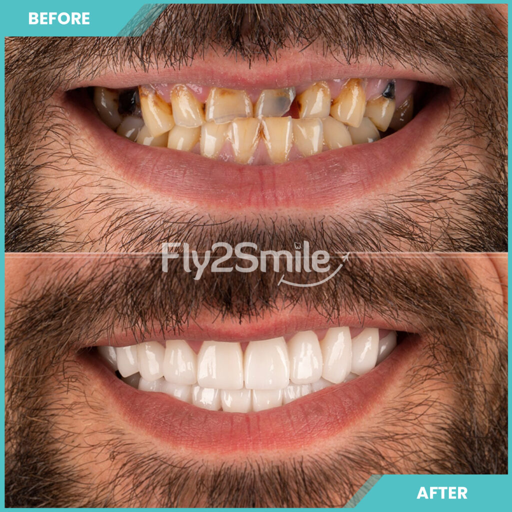 Before and after getting teeth fixed in turkey