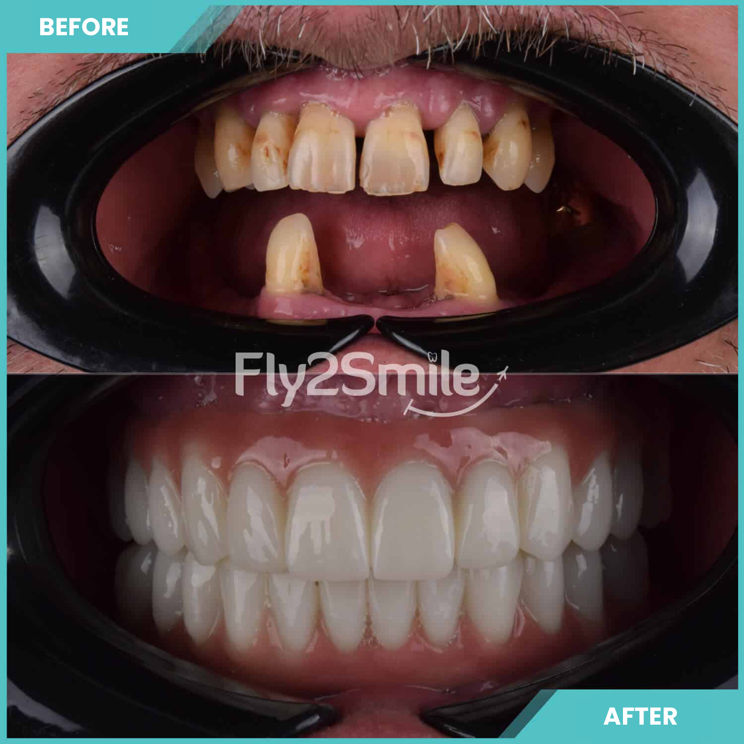 all-on-4-experience-before-after-result