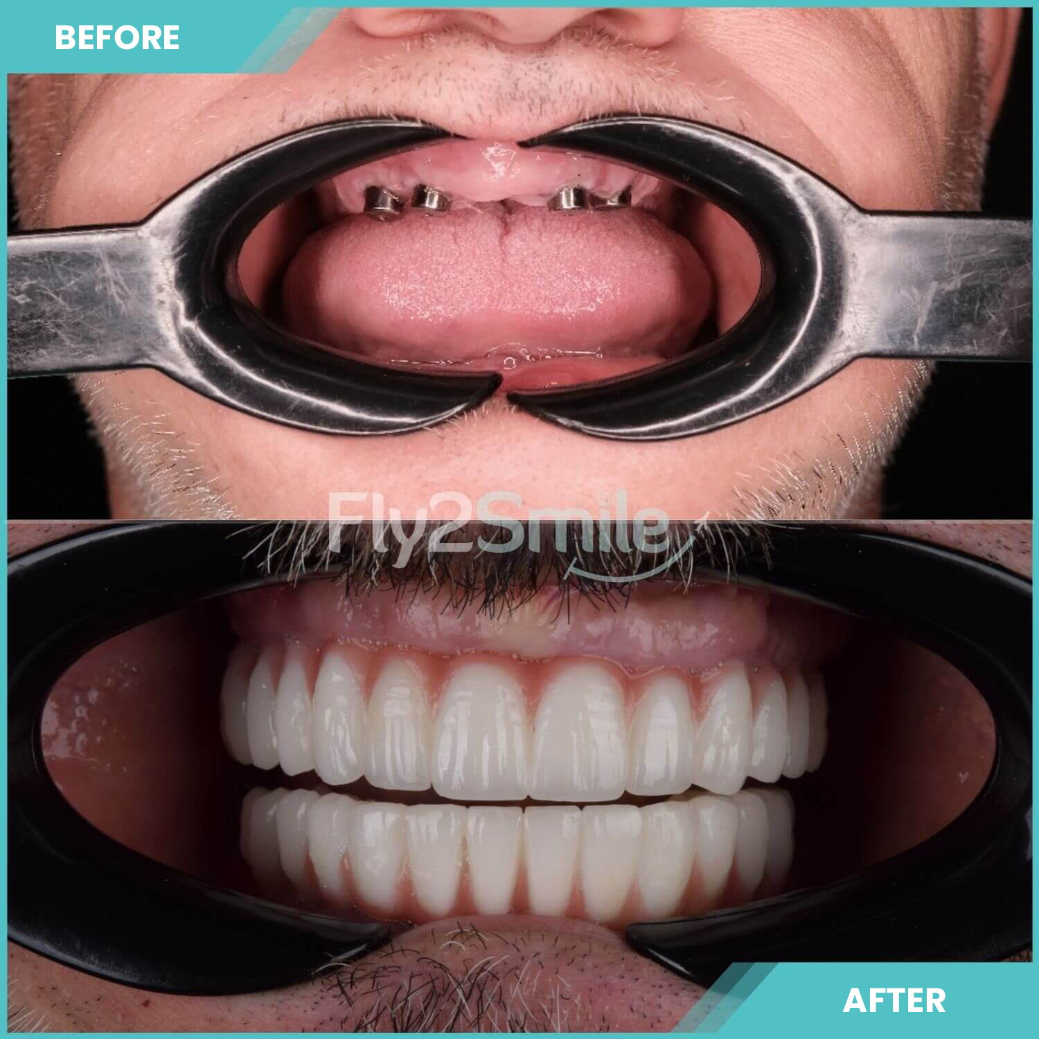 all-on-4-turkey-before-after-result