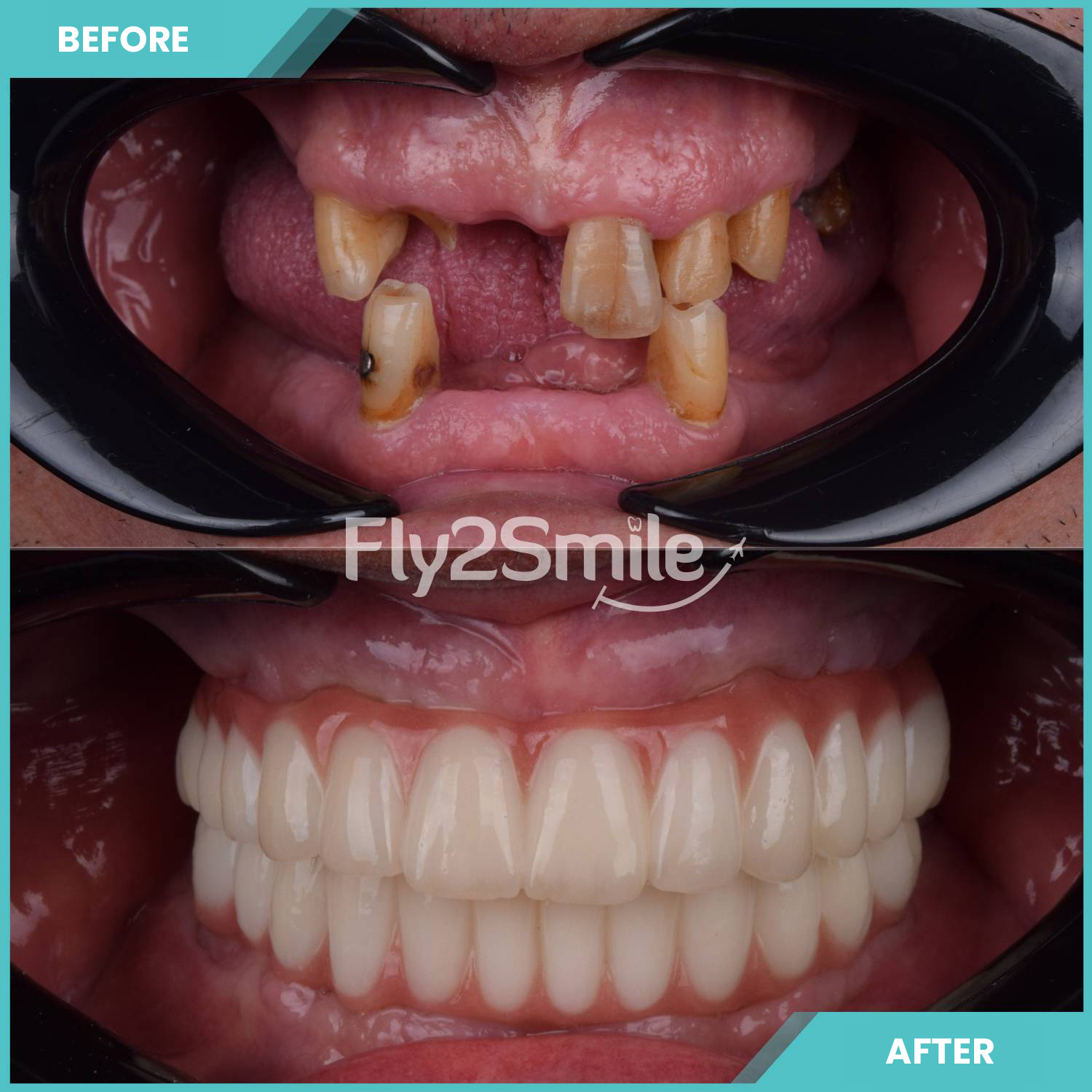 all-on-4-turkey-before-after