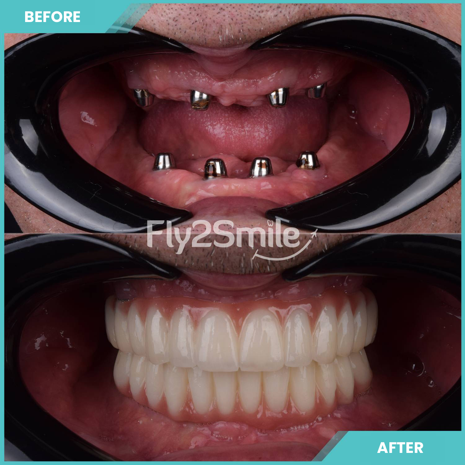 all-on-6-result-in-der-turkey