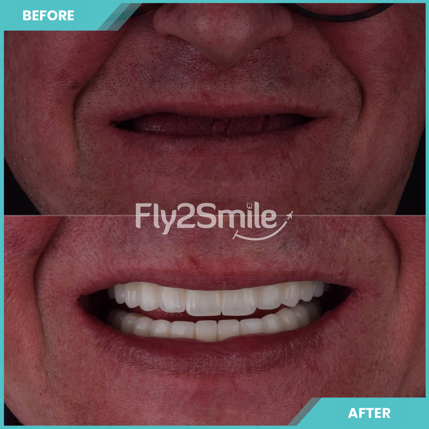 all-on-6-toothimplante-before-after