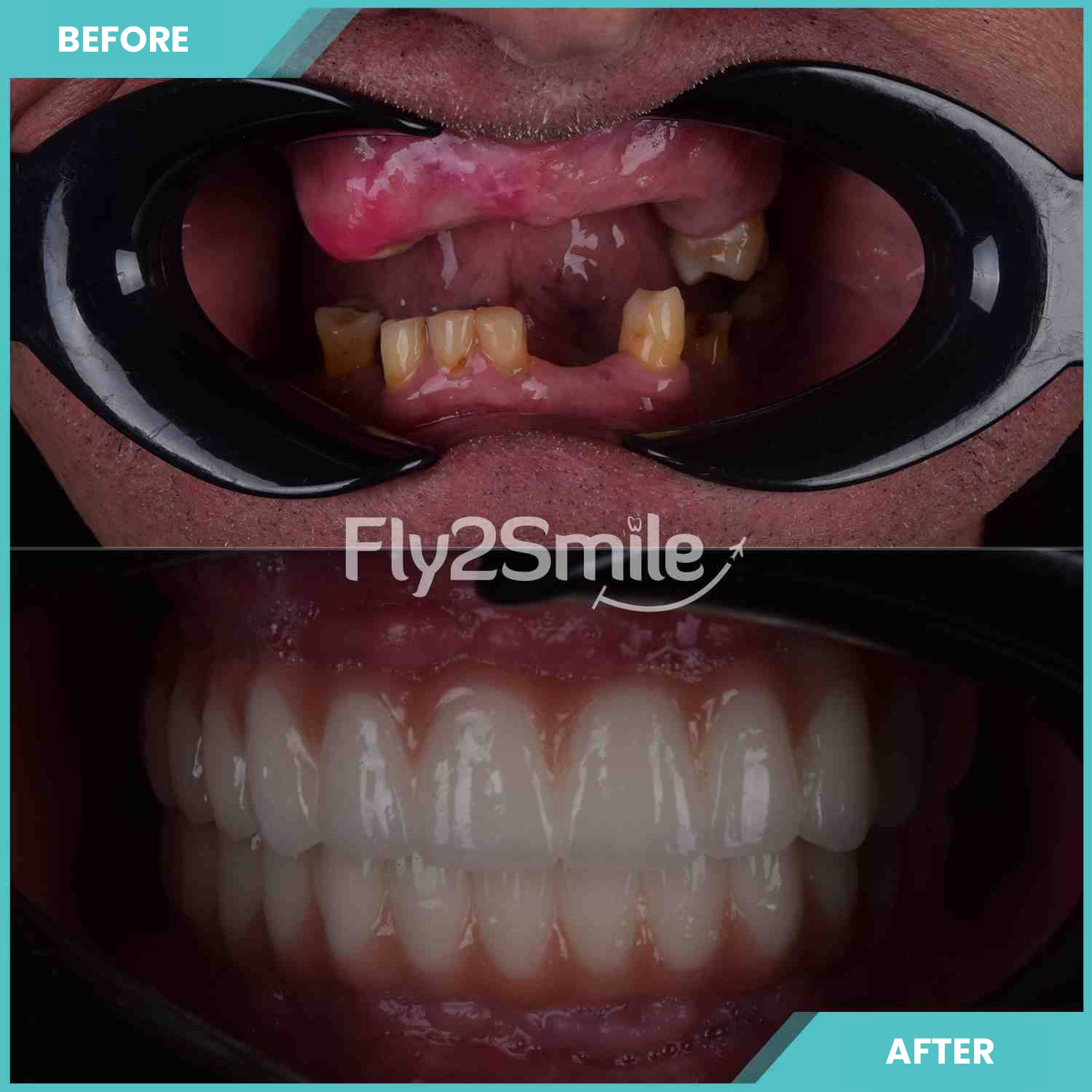all-on-6-turkey-before-after-fly2smile
