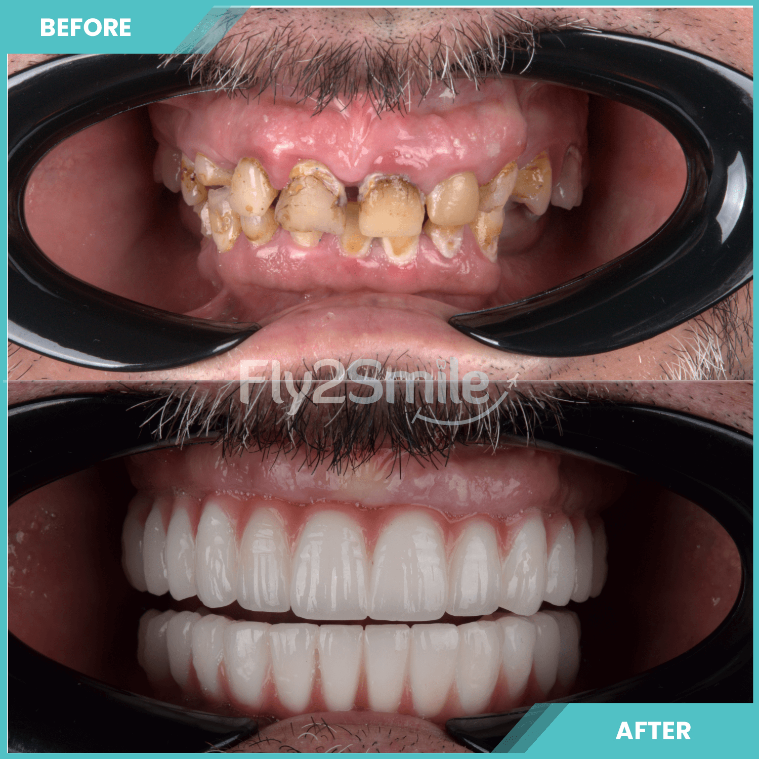 all-on-6-turkey-before-after