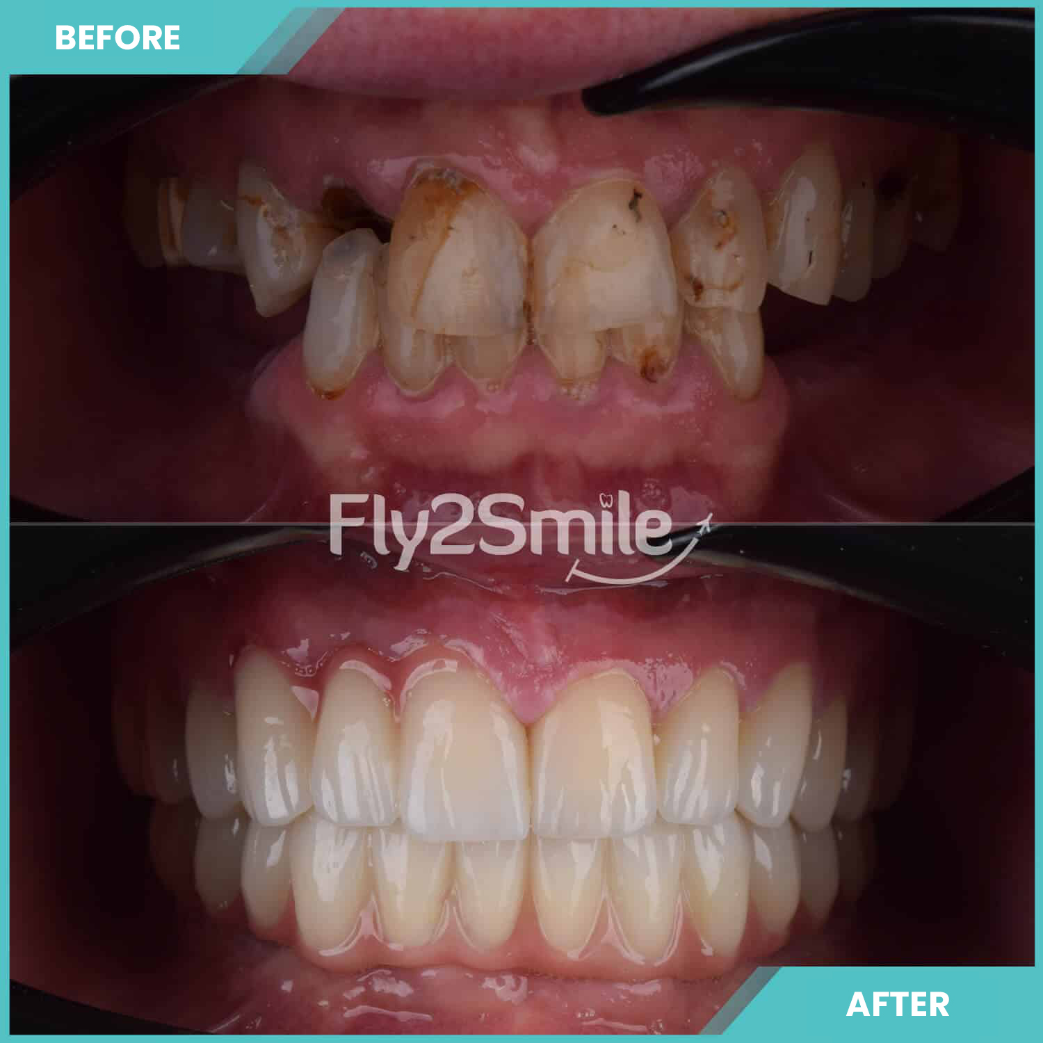 all-on-6-turkey-erfahrung-before-after