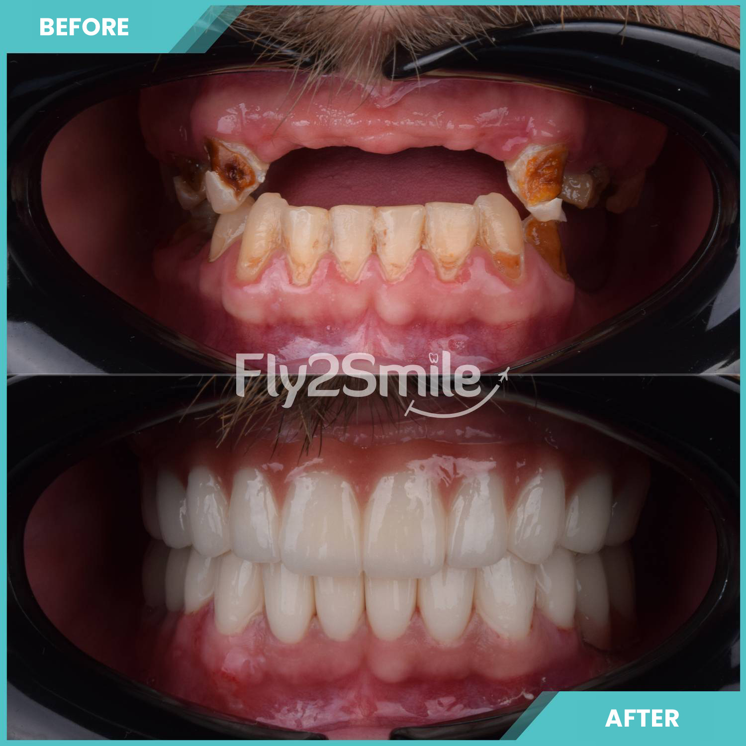 complete-dental-implant-with-fly2smile