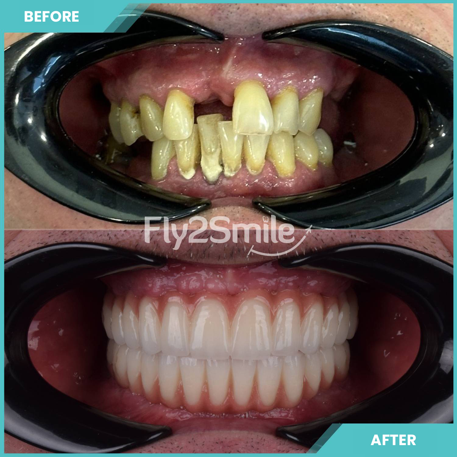 crowns-result-before-after