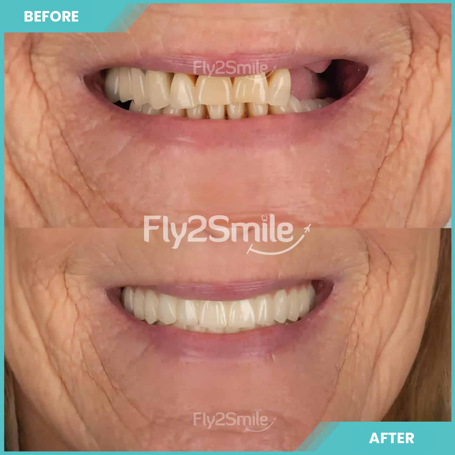 dental-implant-before-after-fly2smile