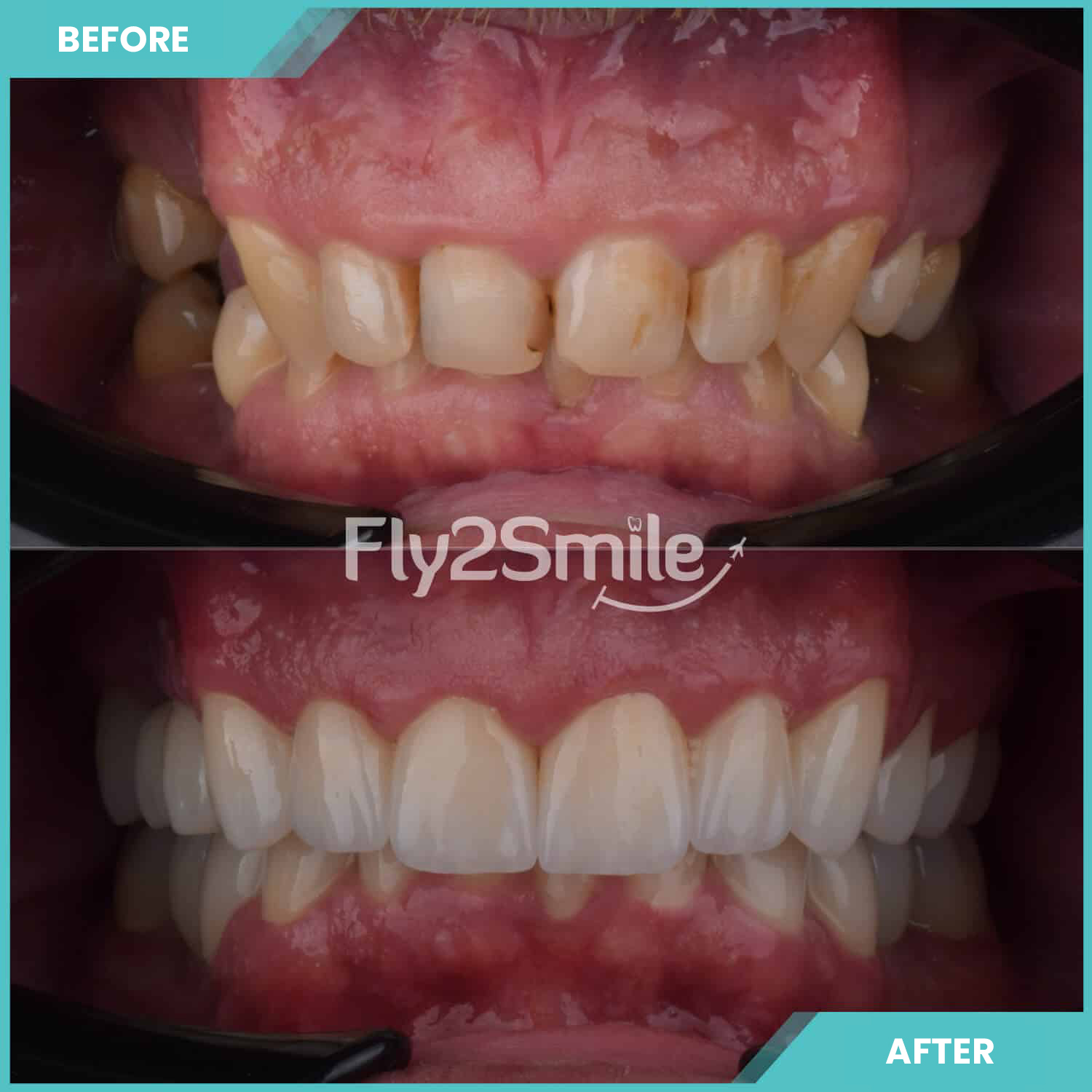 dental-implant-before-after-result-with-fly2smile