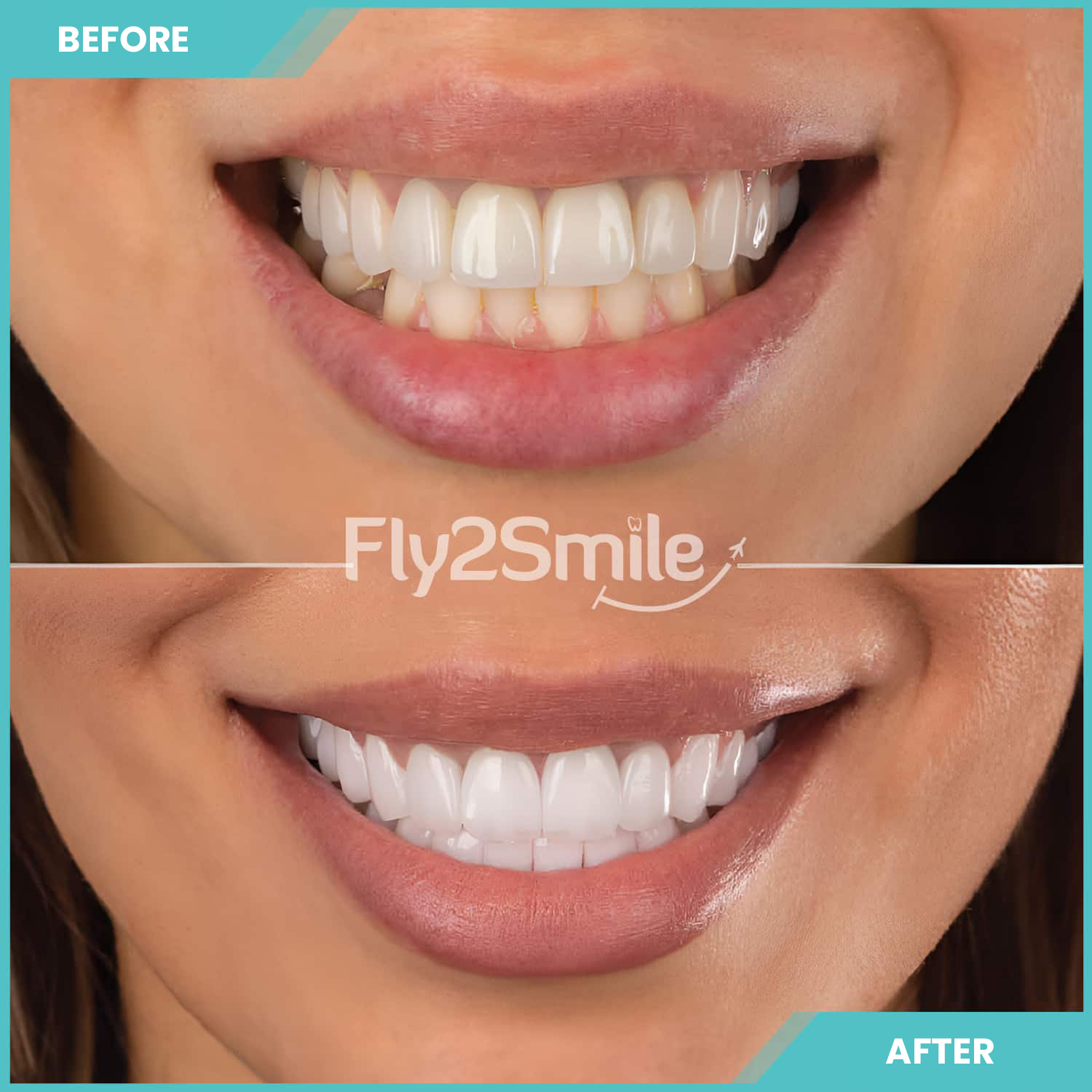 dental-implant-before-after-with-fly2smile-antalya