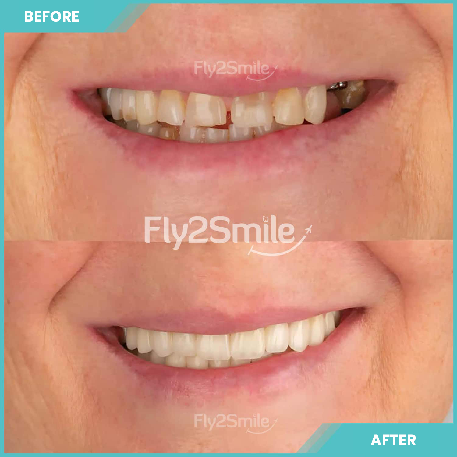 dental-implant-before-after-with-fly2smile