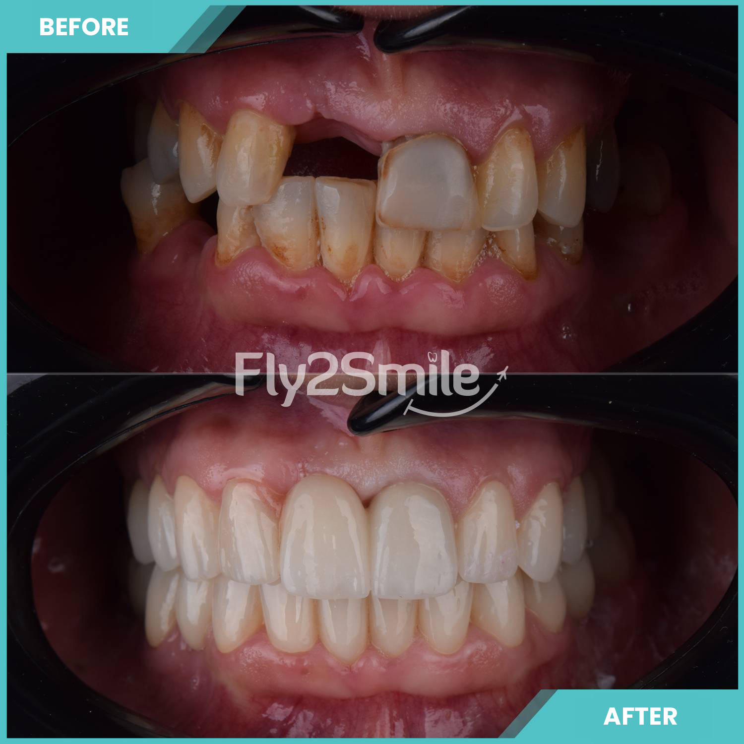 dental-implant-fly2smile-before-after