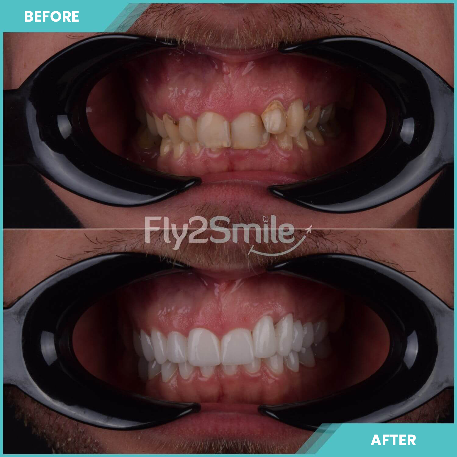 smile-makeover-turkey-before-after