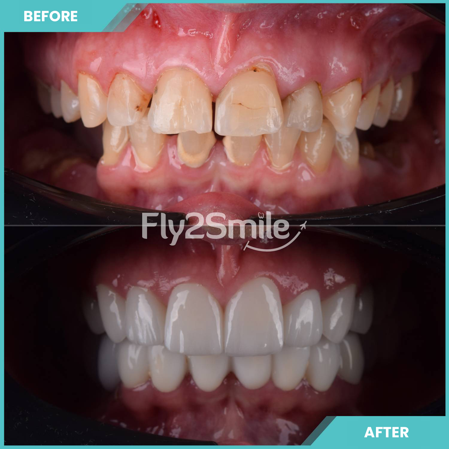 turkey-crowns-teeth-before-after